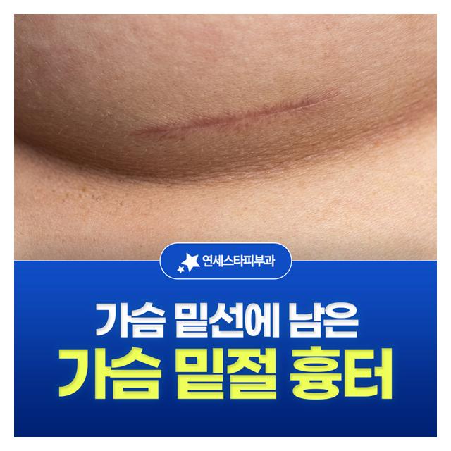가슴 밑절 흉터, 가슴 밑선에 남은 흉터도 치료가능합니다
