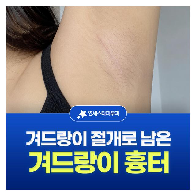 겨드랑이 흉터, 겨드랑이 절개로 남은 흉터치료 25년 솔루션