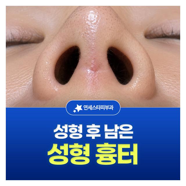 성형 후 남은 성형흉터는 연세스타피부과의 노하우로 치료할 수 있습니다